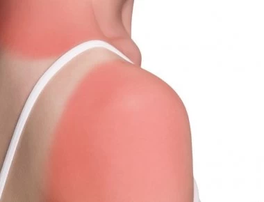 Καρκίνος του δέρματος: Πως θα προστατευτείτε